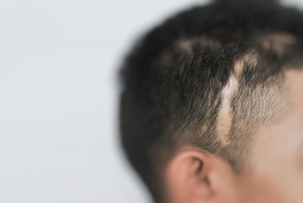 What is scalp micropigmentation