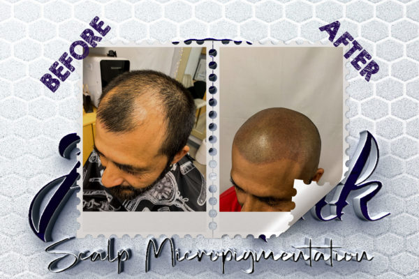 scalp micropigmentation San Diego