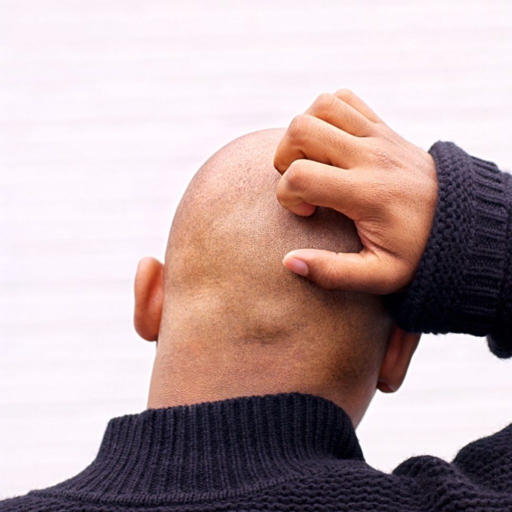 5 important aftercare steps for scalp micropigmentation