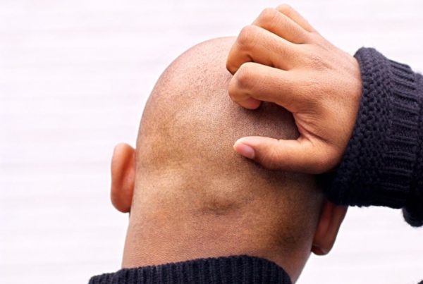 5 important aftercare steps for scalp micropigmentation