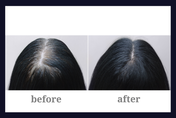 scalp micropigmentation is instant hair
