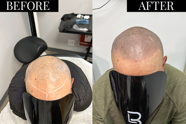 Non-surgical hairline San Diego