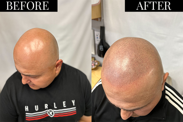 San Diego baldness solution
