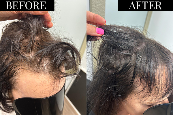 Female Hair Restoration in San Diego