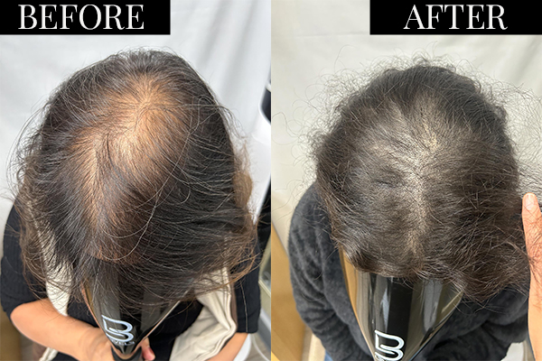 Female Hair Thinning Options in San Diego