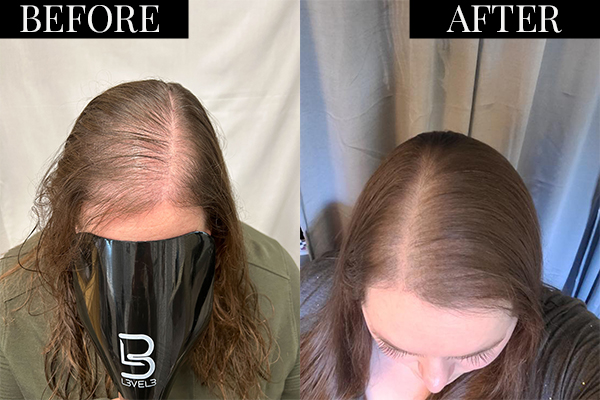 Female Hair Thinning Solutions in Chula Vista